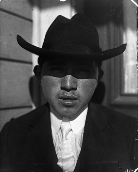 Hearst Museum object titled Black-and-white negative, accession number 15-3543, described as Lip position; adenne